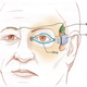 Illustration for article titled An Idea Whose Time Has Come: The Artificial Eyelid